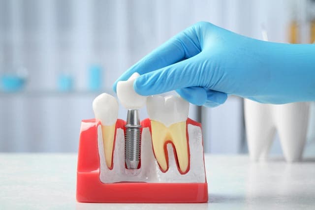 Especialistas en implantes dentales en Ourense