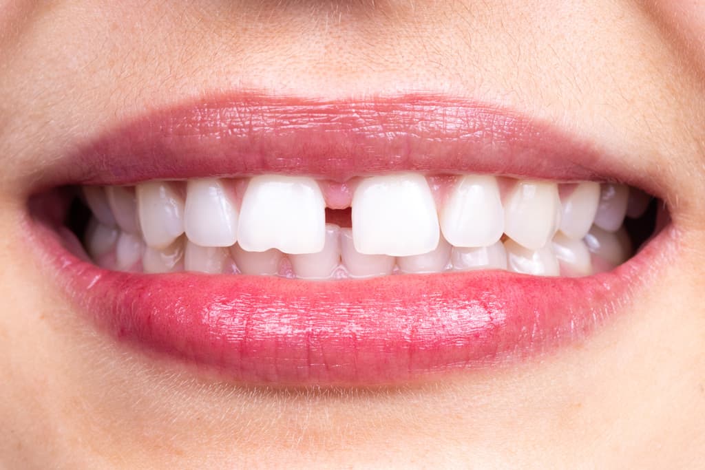 ¿Cuánto cuesta un tratamiento de ortodoncia?