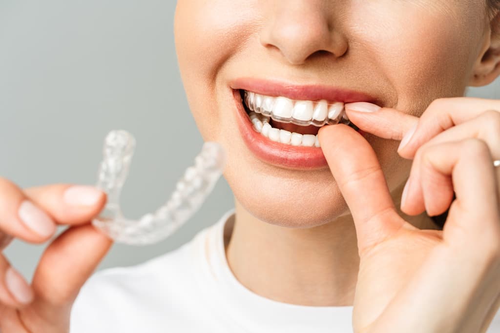 Invisalign: la ortodoncia invisible