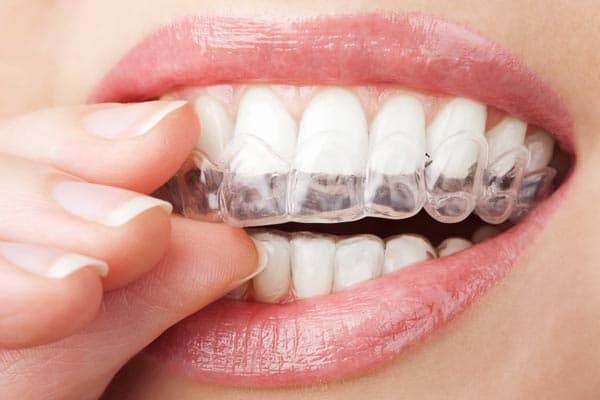 Invisalign: la ortodoncia invisible