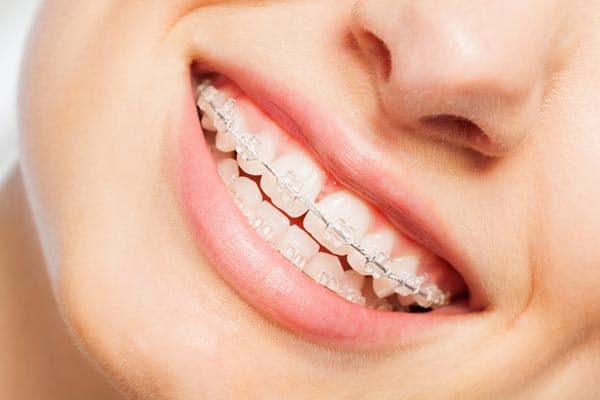 Ortodoncia con brackets