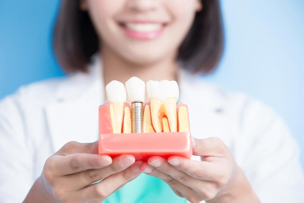 Todo lo que debes saber sobre implantes